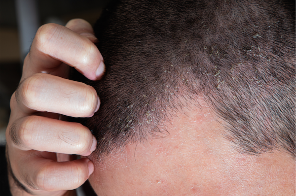 A seborrheás dermatitisz okozta hajhullás és kezelése